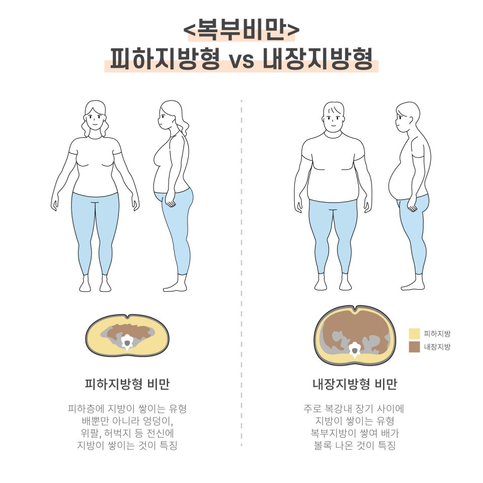 남성의 건강 적신호 복부비만 연예인 피부과 압구정 피부과 실리프팅 지방분해주사 닥터오 메종프리베